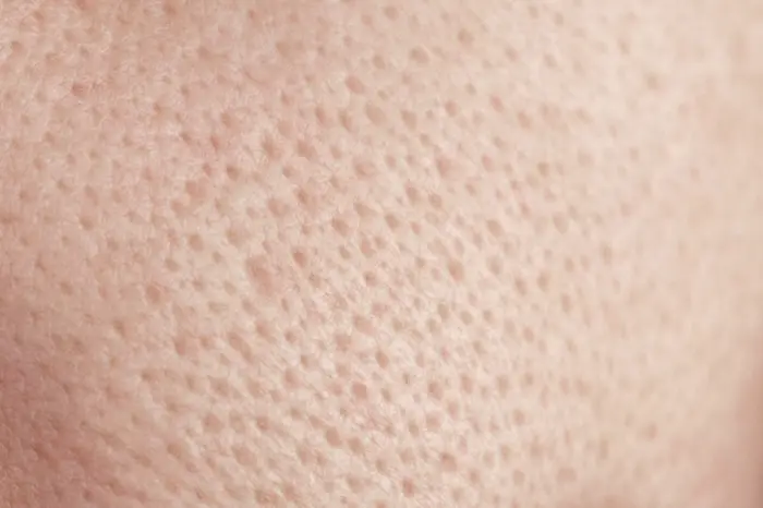 Enlarged Pore