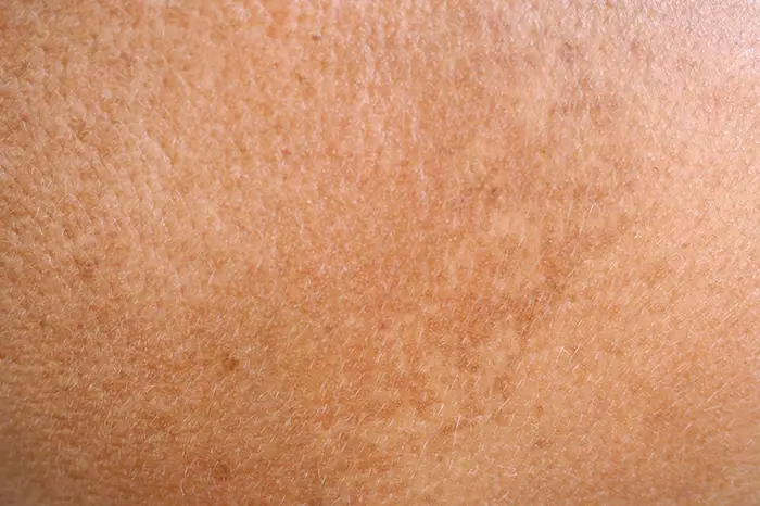 Hyperpigmentation
