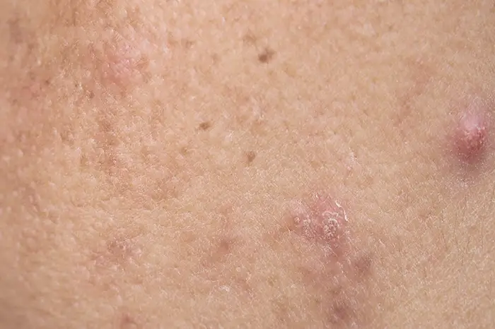 Post Inflamtory Pigmentation