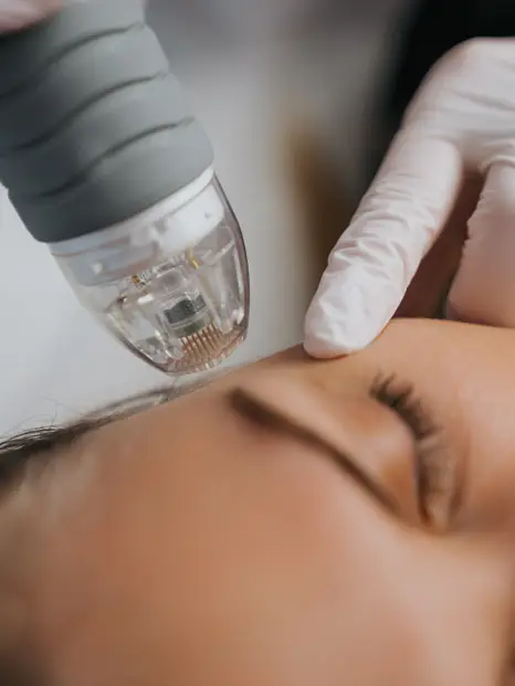 Microneedling RF