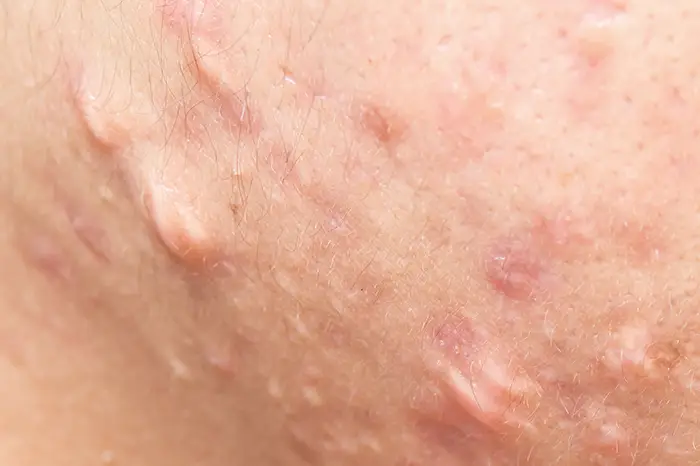 Cystic Lesions Acne Cystic Lesions