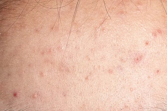 Nodules Acne Nodules