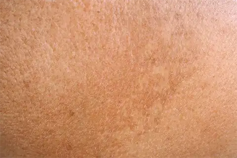 Hyperpigmentation-1-e