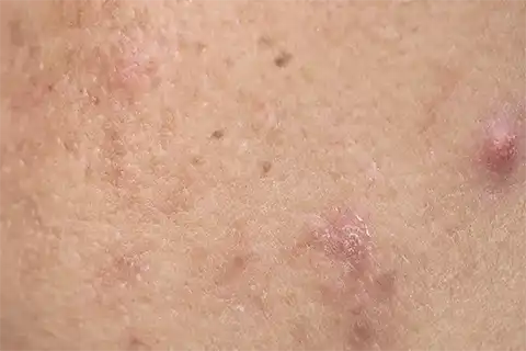 Post-Inflamtory-Pigmentation e