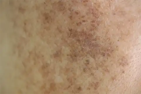 Stubborn-skin-freckle e