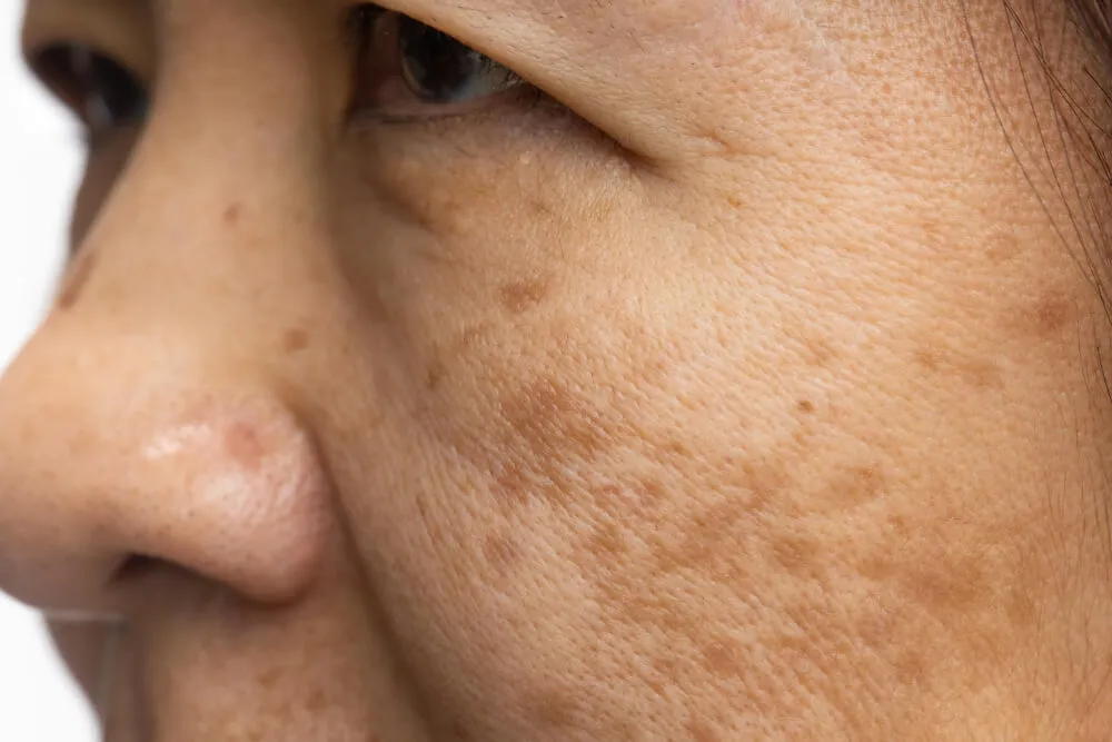 woman with skin hyperpigmentation