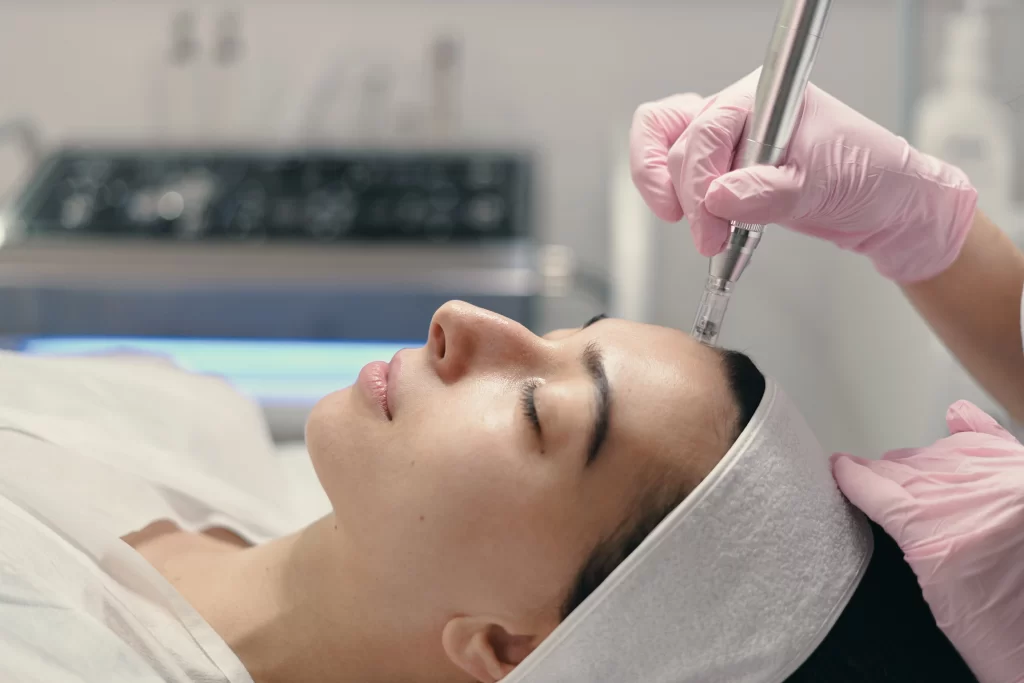 woman getting rf microneedling treatment for her melasma