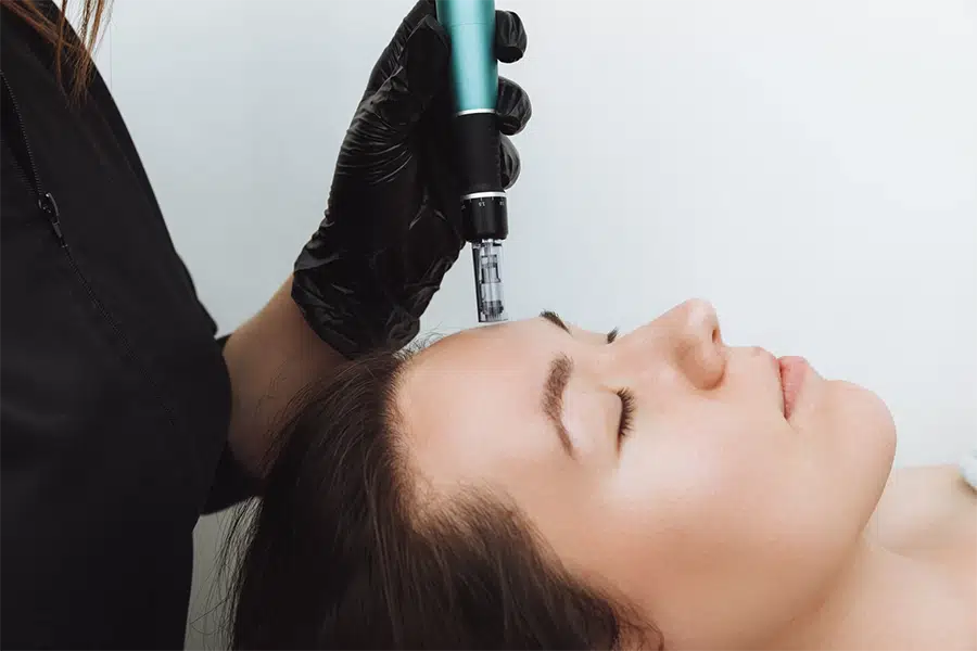 microneedling-rf-scaled-edit