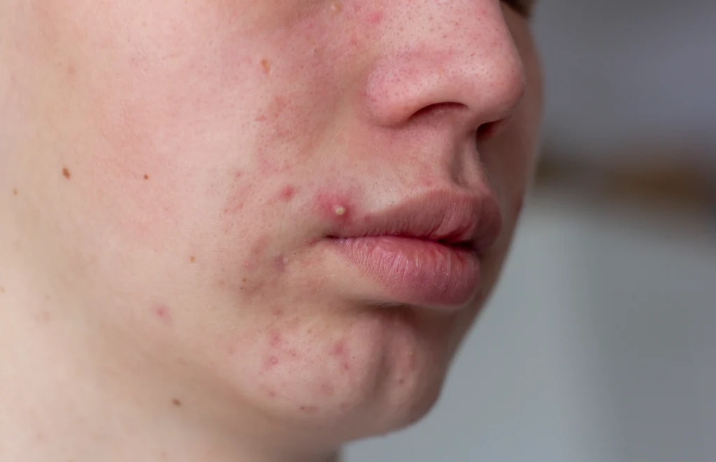 severe acne