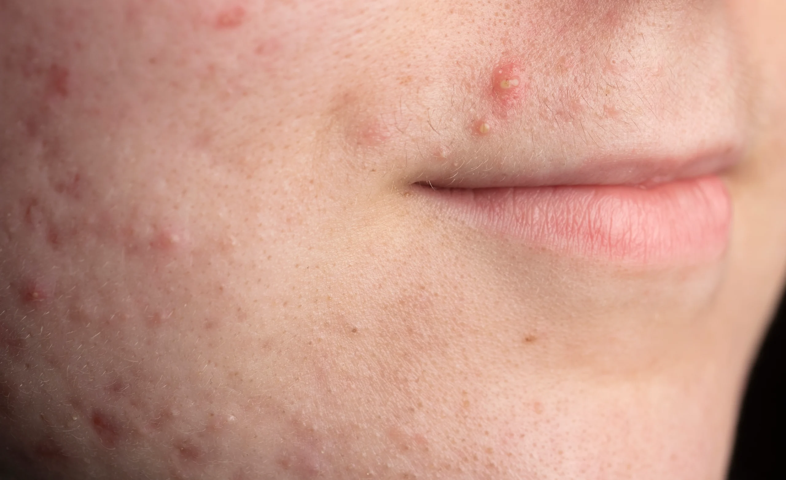 inflammatory acne